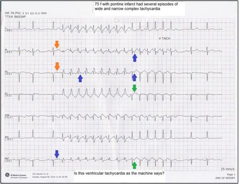 Ecg Rhythms Wide Complex Tachycardia In Cardiac Telemetry