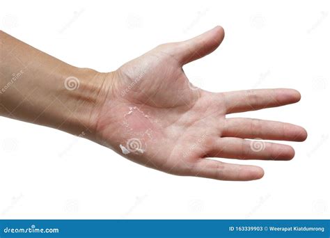 Hand Skin Peeling Stock Image Image Of Peeling Health 163339903