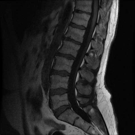 Ct Scan Of Lumbar Spine Doccheck