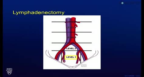 Robotic Pelvic Lymph Node Dissection