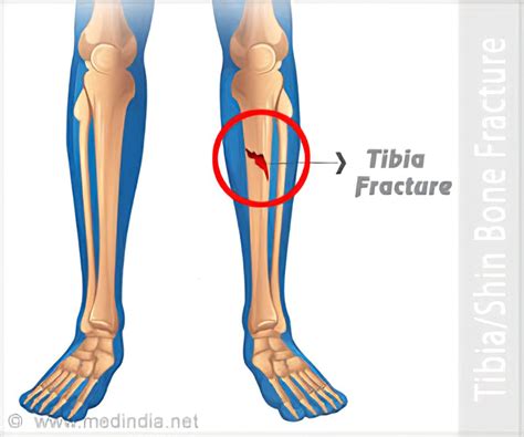 Tibial Shaft Fracture Causes Types Symptoms Diagnosis