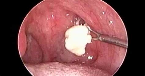 Huge Tonsil Stones Removal In A Case Of Chronic Tonsillitis And Allergic