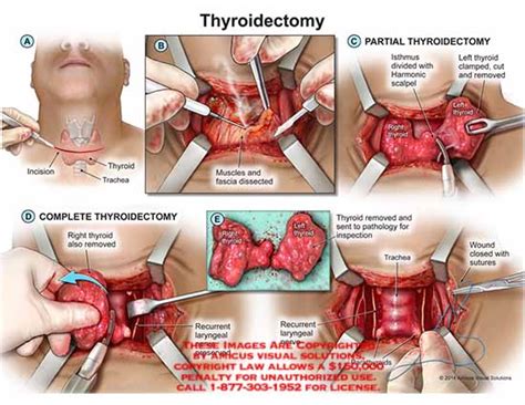 Amicus Illustration Of Amicus Surgery Throidectomy Thyroid Incision