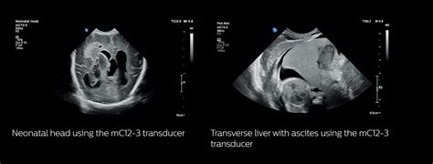Philips Unveils Innovative Ultrasound Solution For Pediatric Assessment