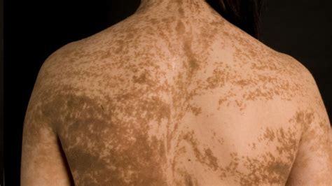 Our Skin Is Covered With Invisible Stripes Mental Floss