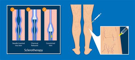 Sclerotherapy Varicose Veins Vitality Vein Care