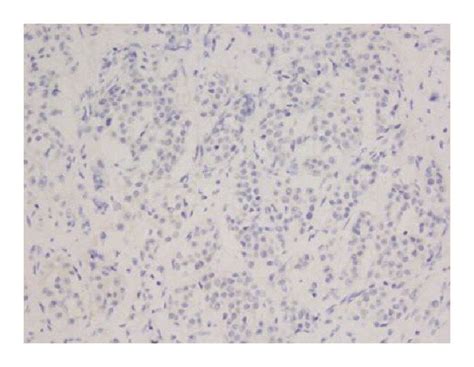 Histologic And Immunophenotypic Features Of Collecting Duct Carcinoma