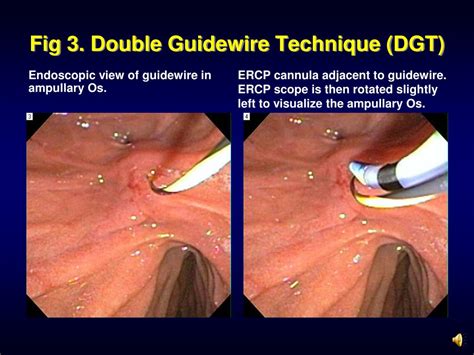 Ppt Double Guidewire Technique Dgt For Difficult Ercp Cannulation
