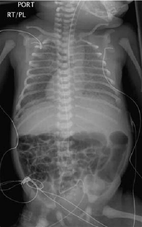 This Total Body Roentgenogram Of An Infant With Heterotaxy Syndrome