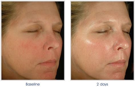 Dull Skin Before After