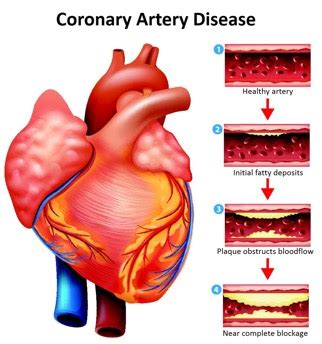 Group Presentation Global Burden Of Disease Coronary Artery