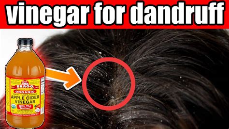 Wet your hair and rub the baking soda on your scalp a few times a week. Best Ways To Use Apple Cider Vinegar For Dandruff ...