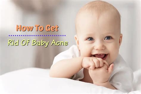 How To Get Rid Of Baby Acne Mom And Baby Blog