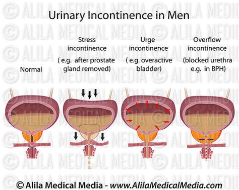 Alila Medical Media Urinary Incontinence In Men Medical Illustration