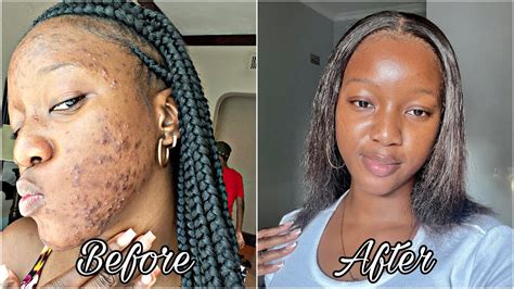 How I Finally Cleared My Acne Prone Skin Skin Care Routine🧴with