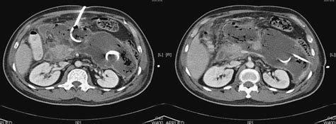 Minimally Invasive Retroperitoneal Pancreatic Necrosectomy I
