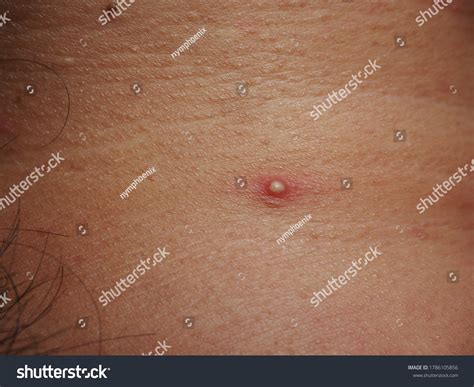 Inflamed Pus Pimple On Skin Pustule Stock Photo 1786105856 Shutterstock