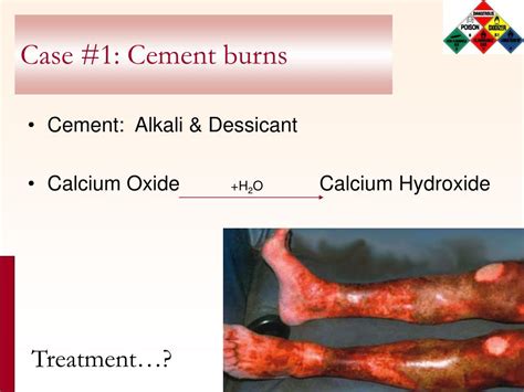 Ppt Chemical Burns Powerpoint Presentation Free Download Id590440