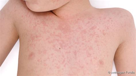 Fifth Disease Symptoms Infection Dangers Therapy Medical Society