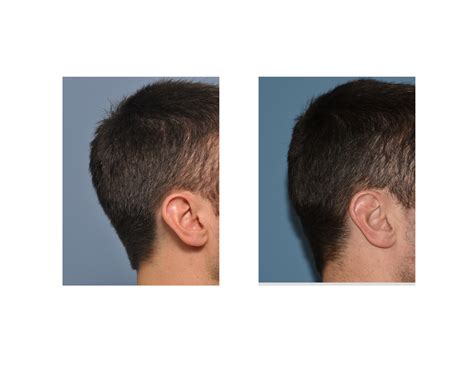 Plastic Surgery Case Study Occipital Skull Reduction Explore