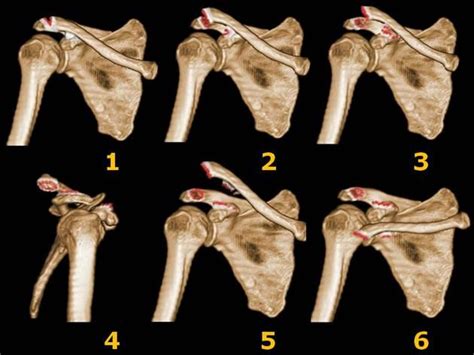 Acromioclavicular Joint Injury Rockwood Classification Radiology