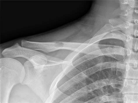 Radiograph Of The Right Clavicle At The Initial X Ray Anteroposterior