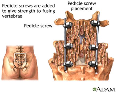 Spinal Fusion Seriespedicle Screw Medlineplus Medical Encyclopedia