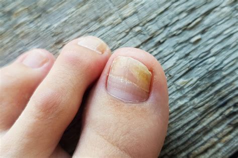 Aggregate More Than Nail Bed Fungal Infection Best Ceg Edu Vn
