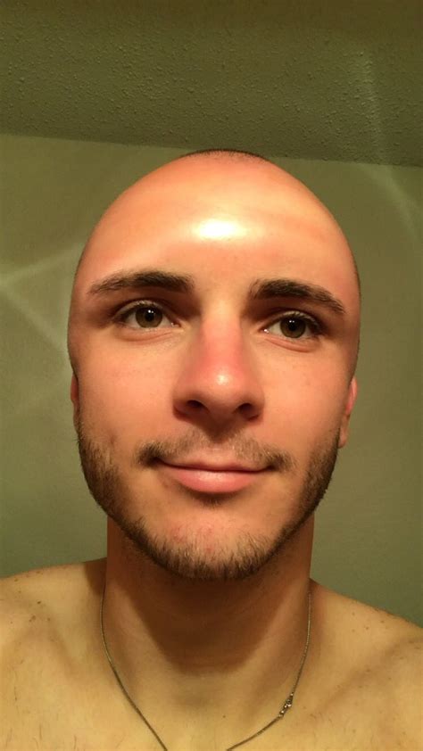 This Guys Head Dent Shows Why Wearing Sunscreen Is So Important