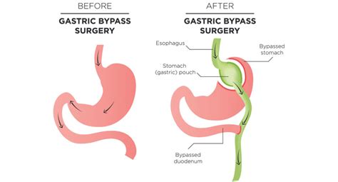 It can take a while to get used to your body's new normal. Gastric Bypass Surgery | How does it help me lose weight?