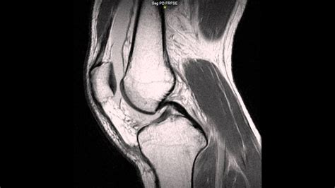 Mri On My Left Knee Possible Torn Meniscus Doctors Please Advise