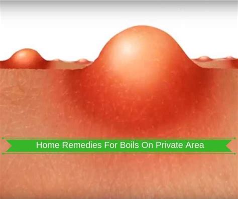 Home Remedies For Boils On Private Area Home Remedy For Boils Skin