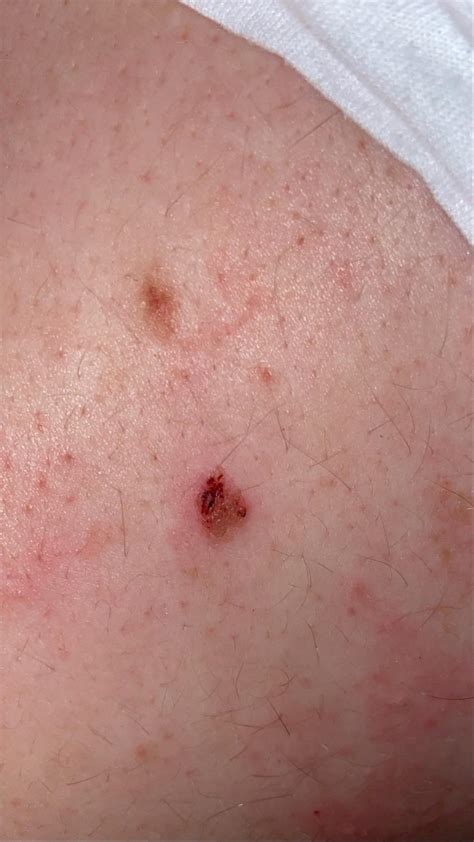So This Mole Is On My Husband Seems To Scab Up Often Im Making Him Go To Get It Checked Out