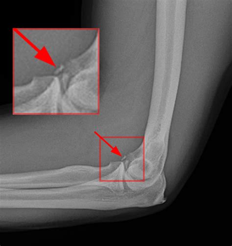 Posteromedial Rotatory Instability Of The Elbow Radsource