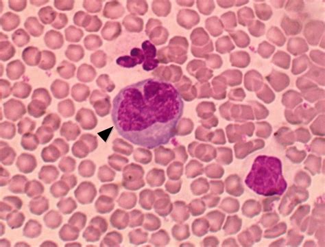 An Activated Monocyte Showing Basophilic Cytoplasm And Coarse Nuclear