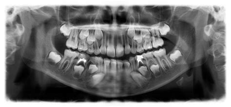 Digital X Rays • Pediatric Dental Specialists • El Dorado Hills Ca