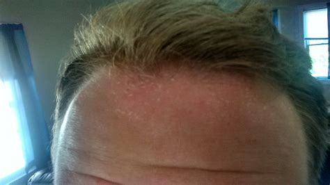 Dry Skin Rash On Forehead
