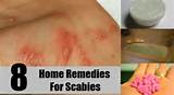 Home Remedies Scabies Humans Pictures