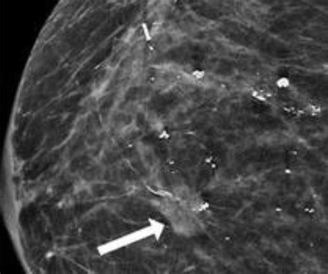 What A New Mammography Study Reveals About Surveillance Imaging In