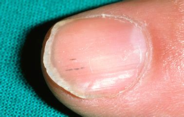 I have psoriasis and it affects my nails; What Your Nails Can Tell You About Your Health | BeesDIY.com