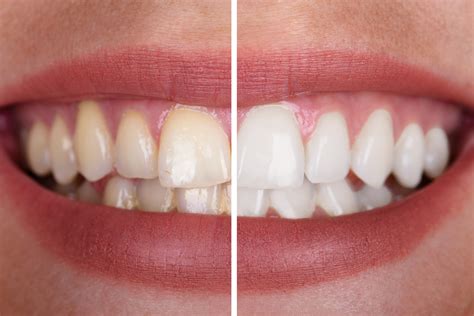 How Professional Teeth Whitening Is Done Greasby Dental Centre