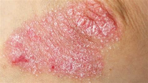 Skin Rashes Eczema