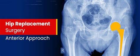 Hip Replacement Surgery Anterior Approach In 2021 Hip Replacement