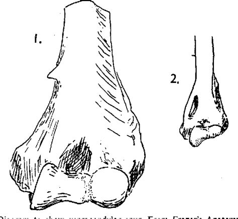 Figure 3 From An Unusual Cause Of Ulnar Nerve Compression Semantic