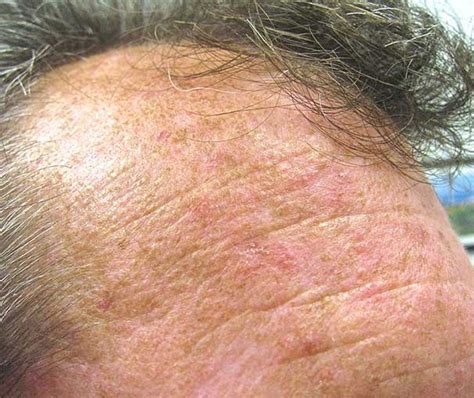 Actinic Keratoses Long Beach Heller Dermatology And Aesthetic Surgery