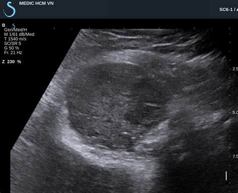 Vietnamese Medic Ultrasound Case 428 Buttock Tumor Asps Dr Phan