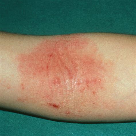 Dermatitis On Elbows