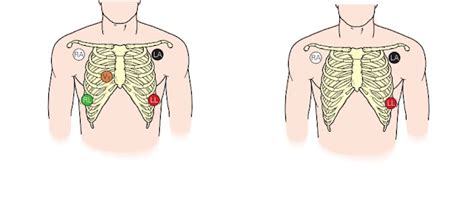 Basic Electrocardiogram Normal And Electrode Placement