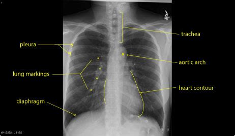 Normally a pa and lateral view are obtained. Normal Chest X-Ray and Lung - radRounds Radiology Network