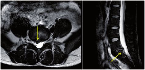 T2 Weighted Magnetic Resonance Images Mri Of The Lumbar Spine